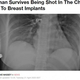 ��������α�ޤä��ƴݡʲ����ϡ�LADbible��2020ǯ4��21���ա�Woman Survives Being Shot In The Chest Due To Breast Implants�ס�Credit: Plastic Surgery Case Studies/McEvenue�ˡ٤Υ����꡼�󥷥�åȡ�