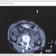 CT�������ǱǤ��Ф��줿���ʥ���Ƭ�ʲ����ϡ�Mirror��2020ǯ6��23���ա�Man inserts 15-inch eel into rear in ��folk remedy�� before it tears hole in his bowels�ס�Image: AsiaWire / Huangjiang Hospital�ˡ٤Υ����꡼�󥷥�åȡ�