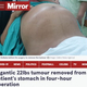 10�����᤯�μ���������Ƥ��������ʲ����ϡ�The Mirror��2021ǯ10��13���ա�Gigantic 22lbs tumour removed from patient's stomach in four-hour operation�ס�Image: Caters News Agency�ˡ٤Υ����꡼�󥷥�åȡ�
